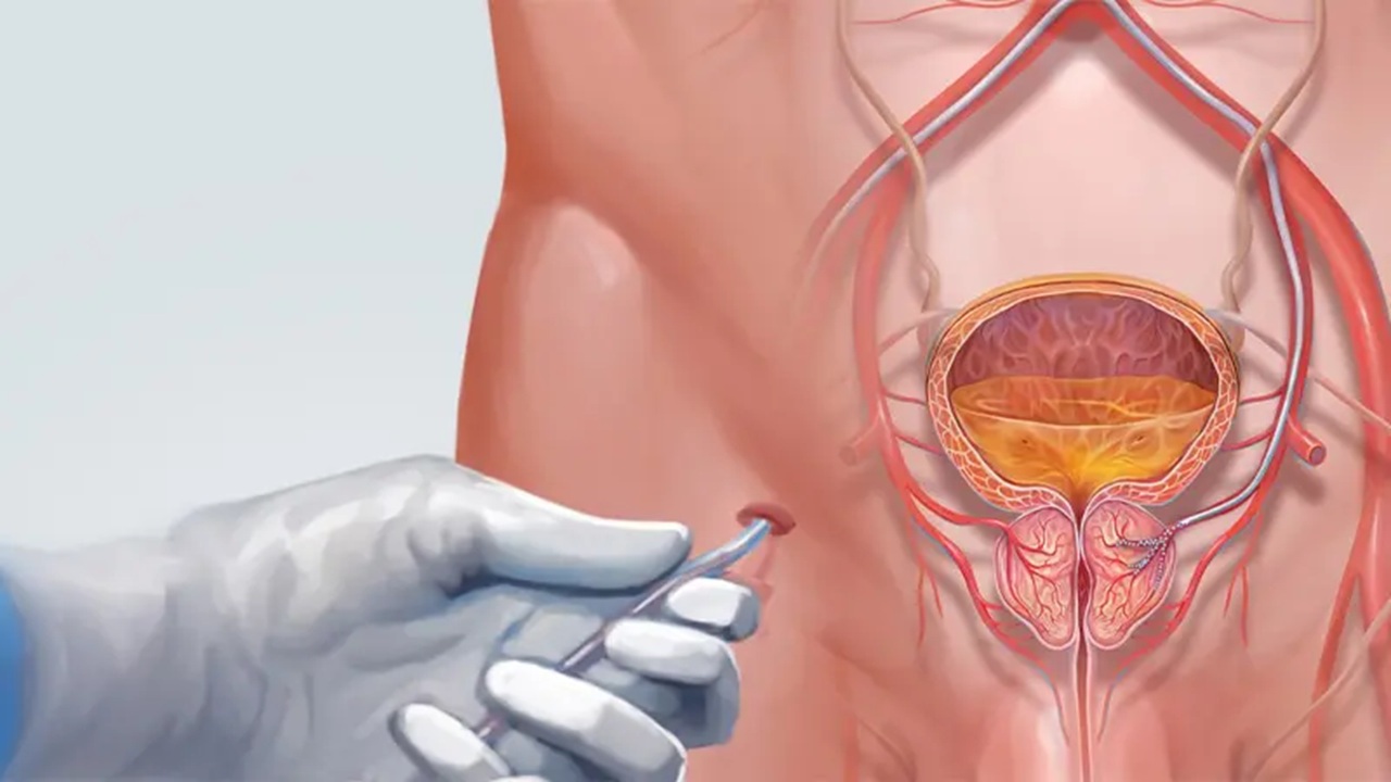 Prostatic artery embolization procedure using catheter based minimally invasive vascular treatment for urinary and reproductive health
