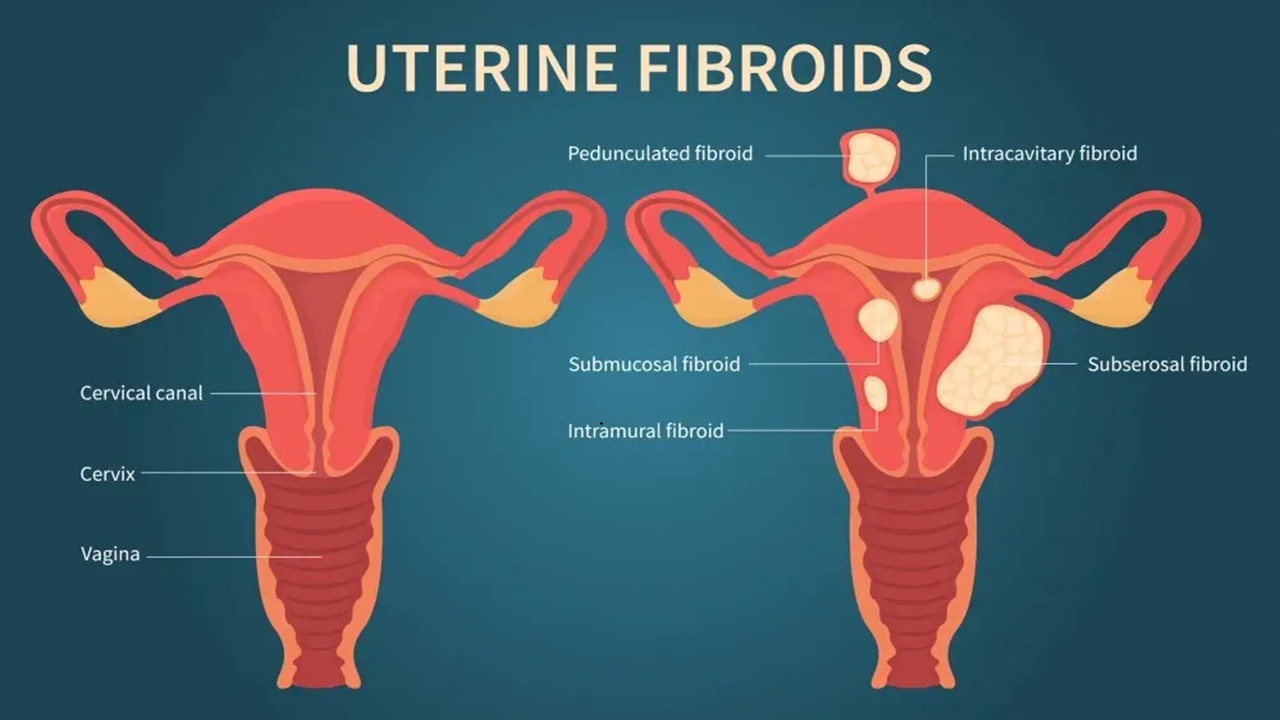 Uterine fibroids types and uterine fibroid embolization treatment shown using image guided minimally invasive fertility procedure